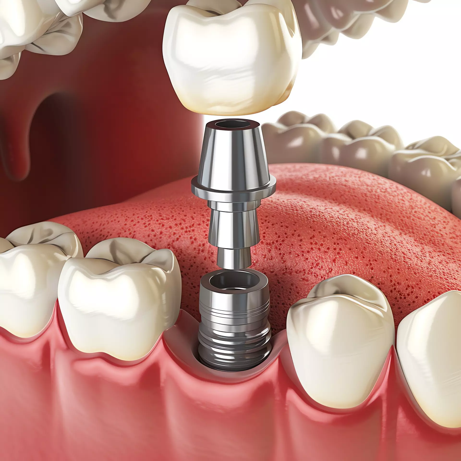 Dental Implants
