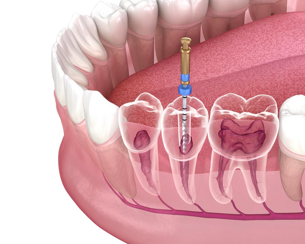 Root Canals